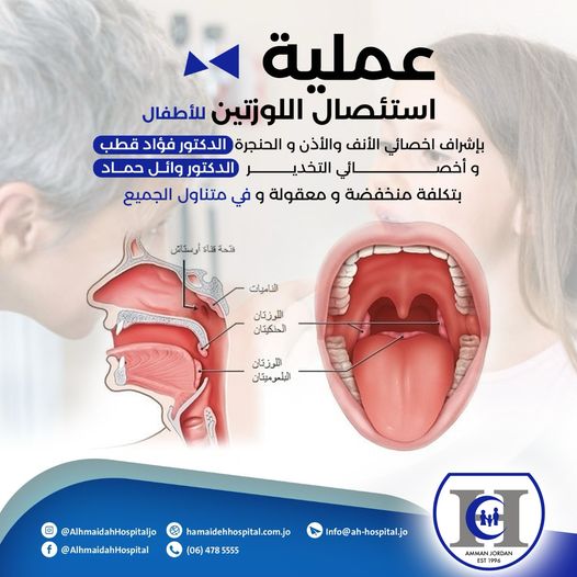 عملية استئصال اللوزتين