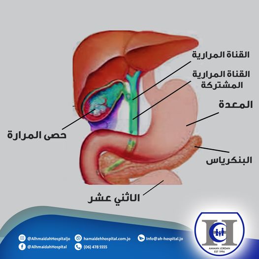 حصى المرارة