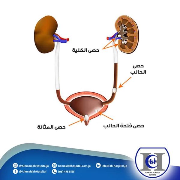 المغص_الكلوي_حصى_الكلى