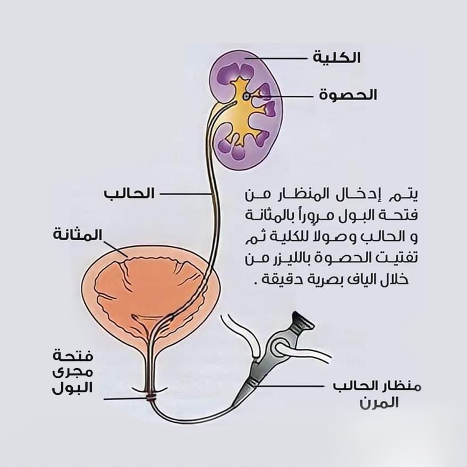 التفتيت بالليزر لحصى الجهاز البولي