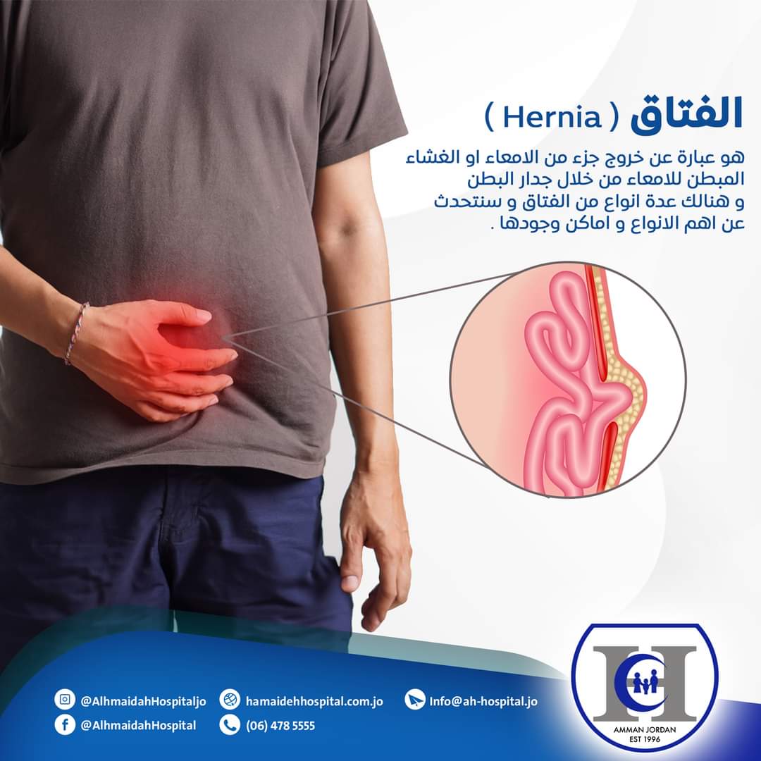 الفتاق Hernia